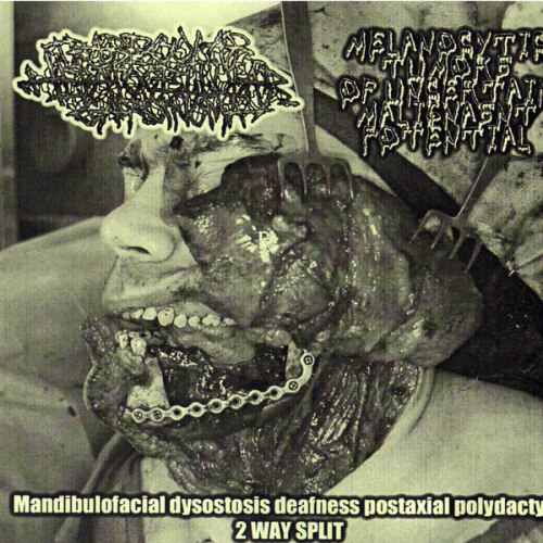 Trabecular Hepatocellular Carcinoma : Melanocytic Tumors of Uncertain Malignant Potential - Trabecular Hepatocellular Carcinoma